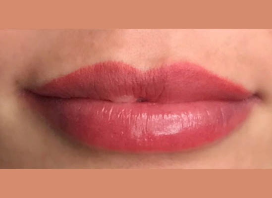 Lip Restoration